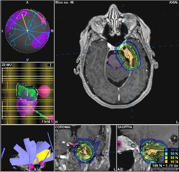 Radiation Therapy